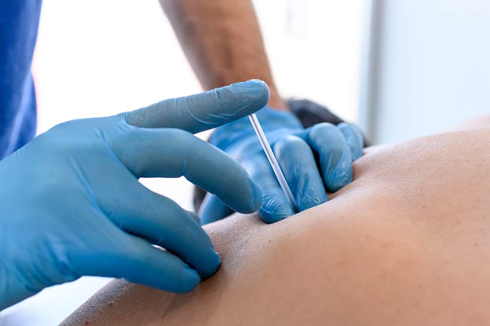 Punción seca en fisioterapia